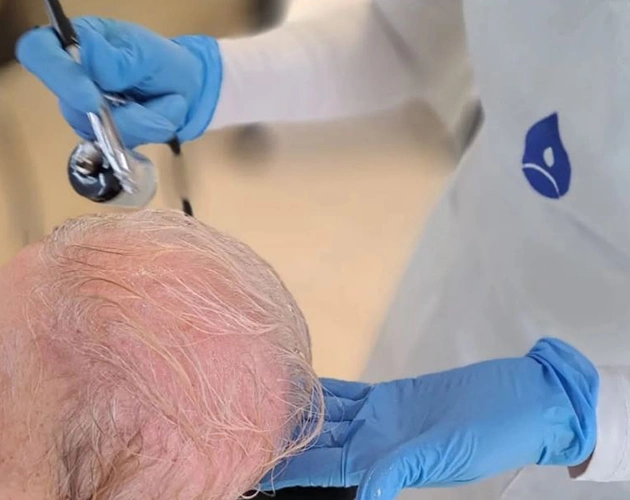 Oxygeni Hair oxigénterápia, fejbőrkezelés, elvékonyodott haj, érzékeny fejbőr, hajnövekedés, Kazincbarcika