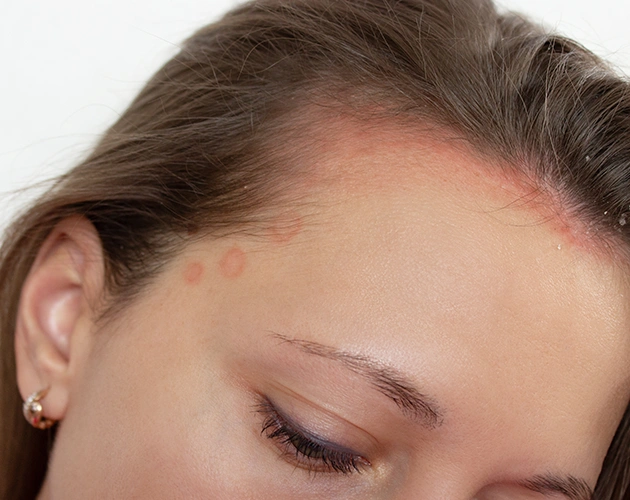 Pikkelysömör, psoriasis, bőrbetegség, hámlás, gyulladás, hajgyógyászat, Kazincbarcika